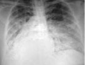lung